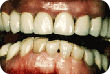 Teeth showing signs of tooth abrasion