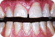 Teeth showing signs of tooth attrition