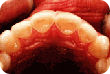 Teeth showing signs of tooth erosion