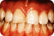 Teeth showing signs of tooth erosion