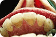 Teeth showing signs of tooth erosion